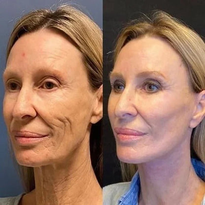 SkinLift™ - Botox Ansiktsserum