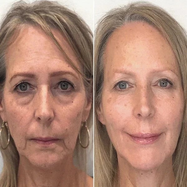 SkinLift™ - Botox Ansiktsserum